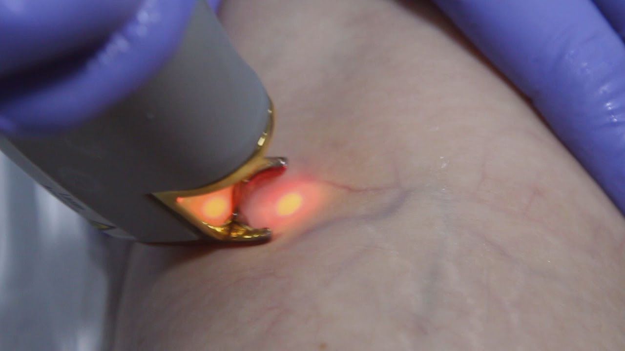 Убрать КУПЕРОЗ Лазером. Как это работает?