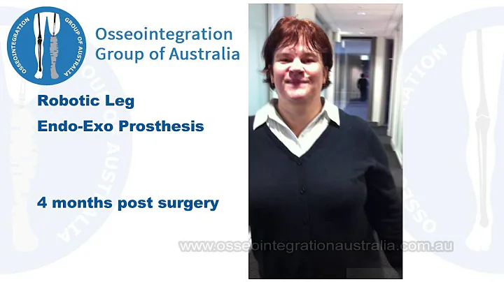 Osseointegration Patients - 4 months post surgery