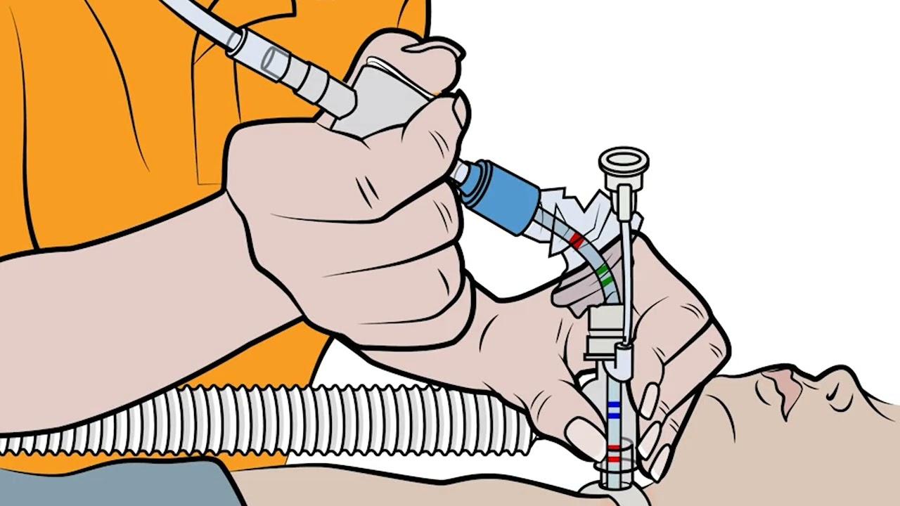AirLife Ballard Closed Suction Home Care Guide – Pediatric Tracheostomy (VID-20055-C1)