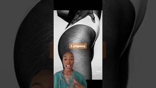 4 causes of stretch marks EXPLAINED **part 2** #stretchmarks #doctorexplaine