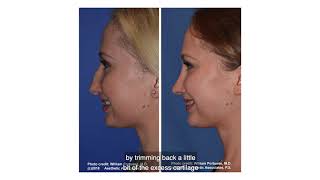 Rhinoplasty : Fixing a Hanging Columella  -  Do I have a Hanging Columella