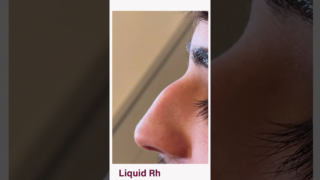 Liquid Rhinoplasty - Dr Muhammad Tahir - Laser Praxis Cosmetic Surgery Clinic.