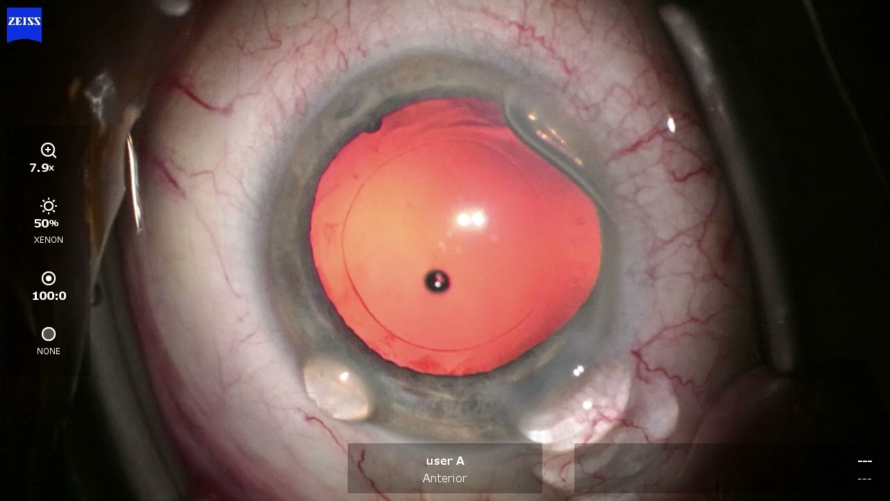 OS 2025 02 13 112059 phaco 