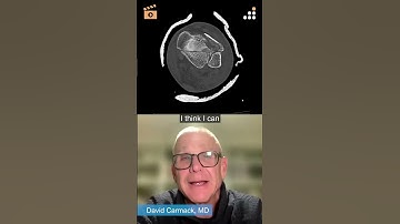 Anterolateral Approach for Pilon ORIF