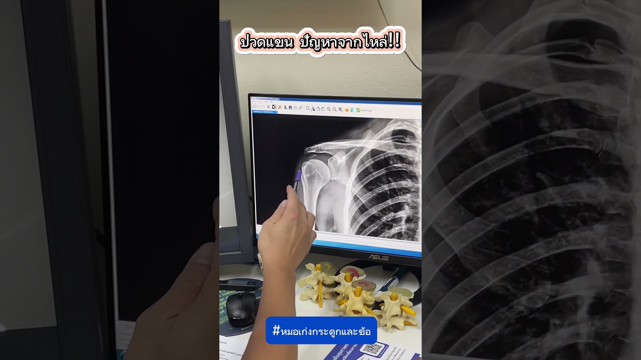 ปวดแขน ปัญหาจากไหล่!!! #หมอเก่งกระดูกและข้อ #ปวดแขน #ปวดไหล่ #เอ็นอักเสบ #เอ็นขาด