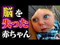 【実話】脳がない状態で生まれた奇跡の子