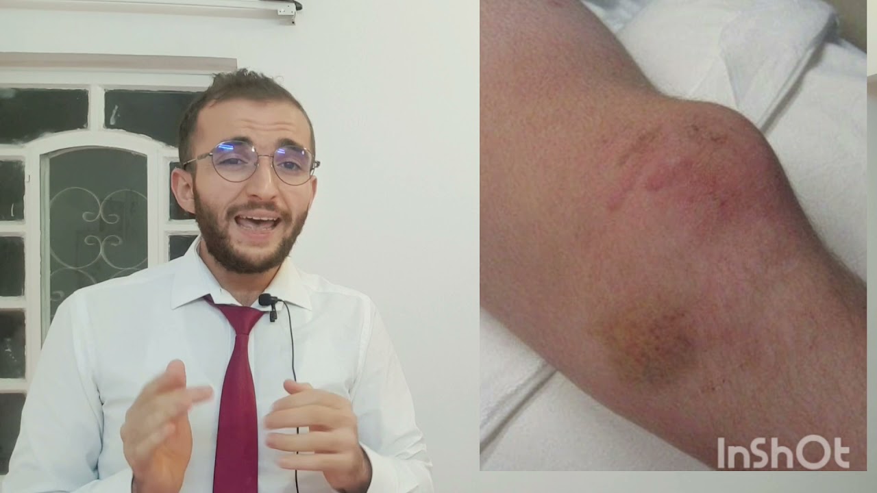 LL: Knee dislocation l خلع الركبة