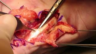 Removal of Gouty deposits in the soft tissue of the hand screenshot 2