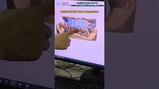 dental model data comparison.#dental #china #dentalclinic