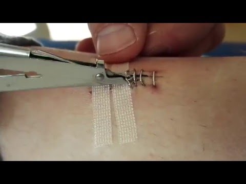 Video: Chirurgische Klammern entfernen - Gunook