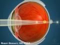 How Orthokeratology Works