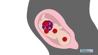 In utero transfusion gives meaningful survival to fetuses with alpha thalassemia major