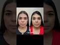 Rinoplastia Dr Jaimes 22/01/25