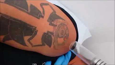 THE R20 METHOD   LASER TATTOO REMOVAL