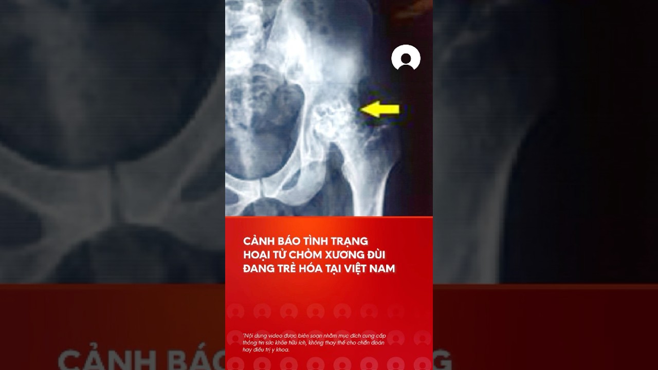 Cáº£nh bÃ¡o hoáº¡i tá»­ chá»m xÆ°Æ¡ng Ä‘Ã¹i, pháº£i thay khá»›p hÃ¡ng gia tÄƒng á»Ÿ ngÆ°á»i tráº» Viá»‡t Nam #cáº£nhbÃ¡osá»©ckhá»e