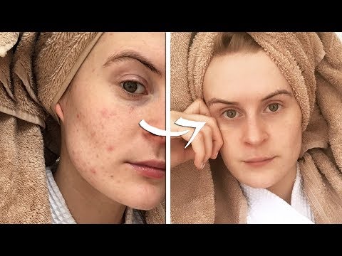 Does veganism AUTOMATICALLY cure acne?