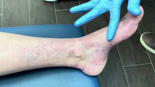 Small Red Veins That Are Hard To Treat - Generalized Essential Telangiectasia