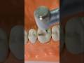 Incrustación dental