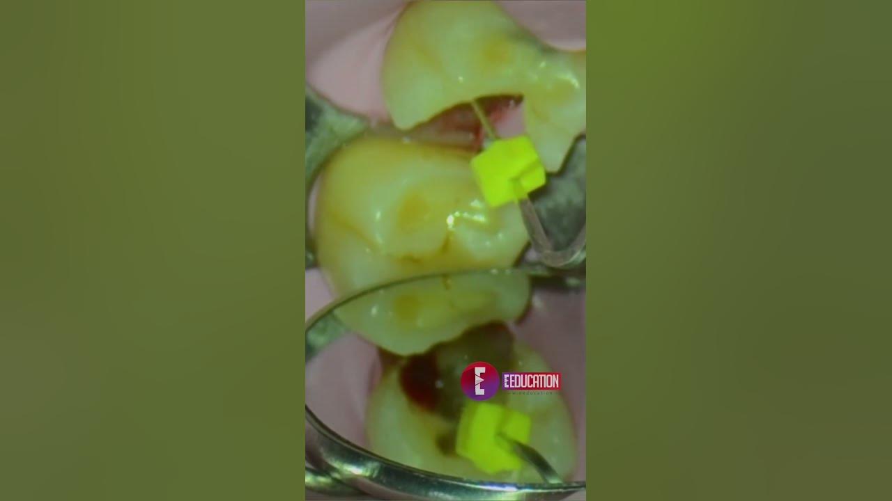 Using apex locators Dentistry Endodontics Dr. Agam Bhatnagar