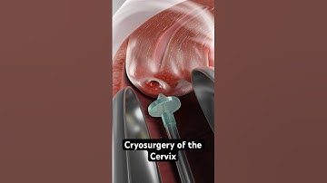 Freezing abnormal cells to prevent cervical cancer (3D Animation)