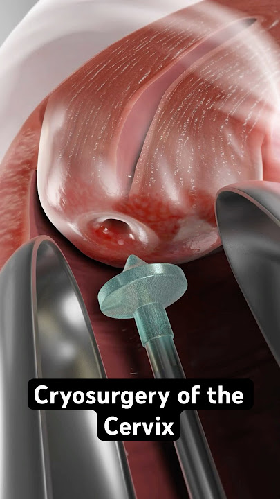 Freezing abnormal cells to prevent cervical cancer (3D Animation)