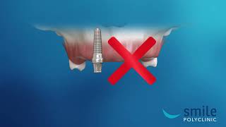 SUBPERIOSTAL IMPLANTS - Custom Made Implant - Smile Dental Clinic - Opatija (Croatia) screenshot 4