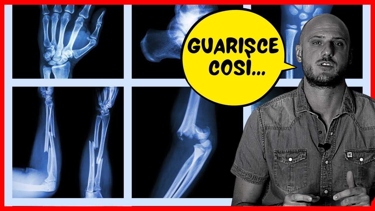 ✔️ Как заживают переломы | Образование костной мозоли и первичное заживление