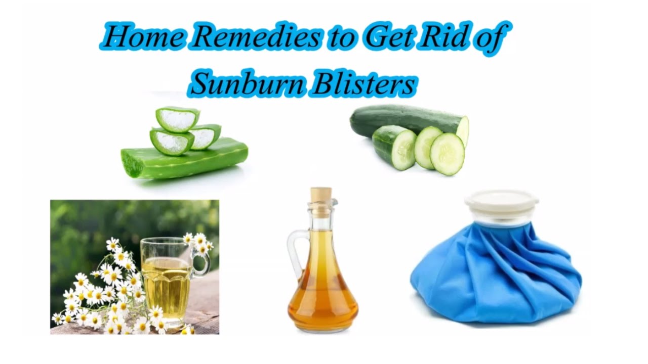 7 Home Remedies To Get Rid Of Sunburn Blisters Youtube