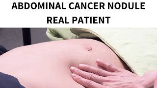 Real Patient's Cancer Diagnosis Physical Exam - Stanford Global 25 (Taiwan)