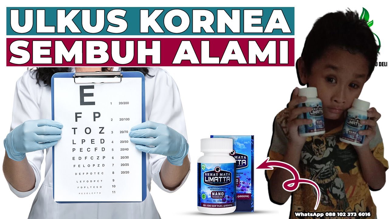 Cara Menyembuhkan Ulkus Kornea atau Kornea Mata Luka Secara Alami