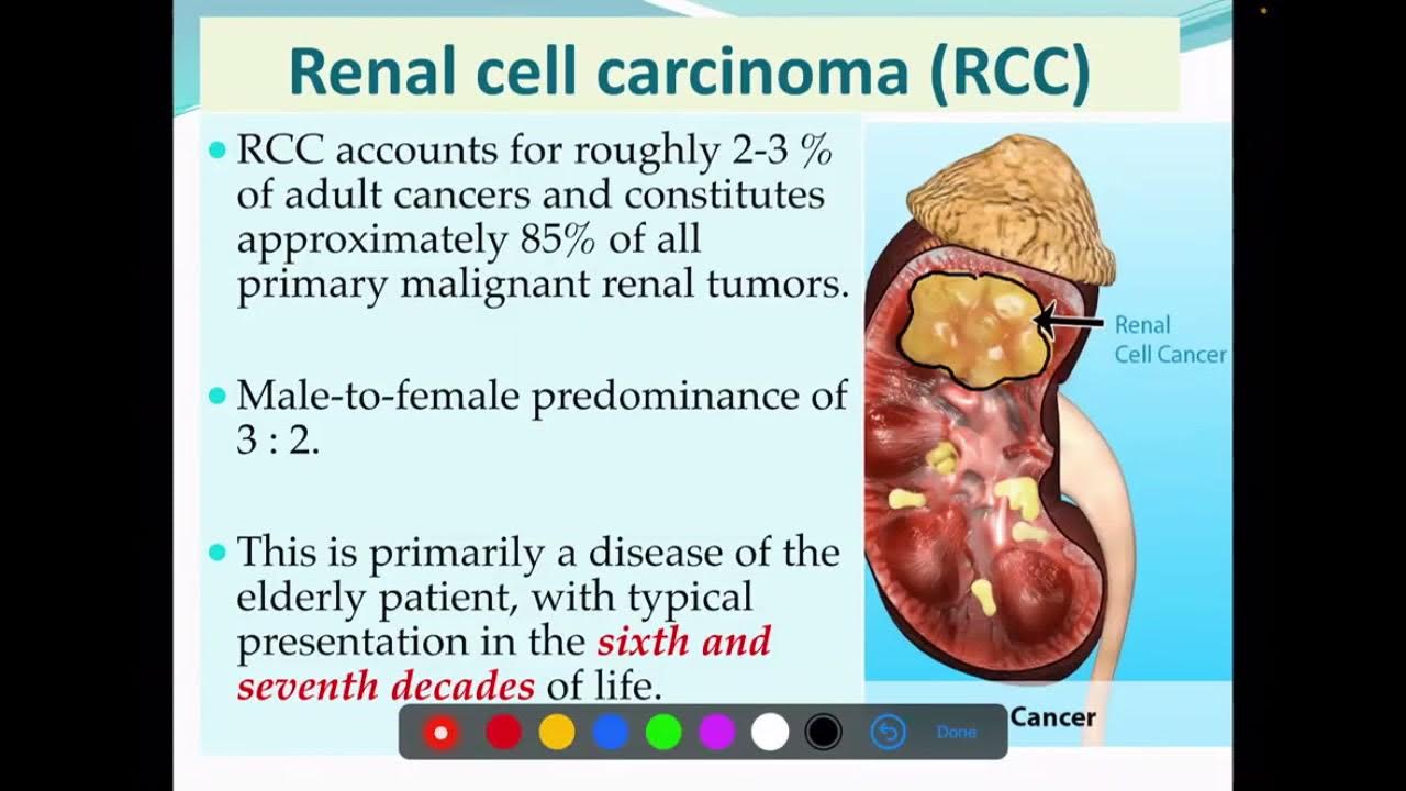 renal-cell-carcinoma-rcc-aetiology-histopathology-spread-youtube