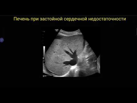 Печень при застойной сердечной недостаточности(nutmeg liver)