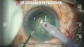 Mechanical chop for Phacoemulsification by Dr Sourabh Patwardhan