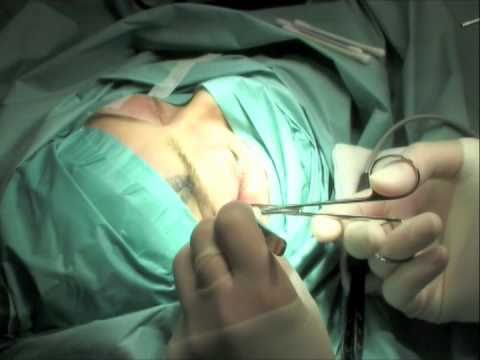 Orbital Decompression Surgery.m4v