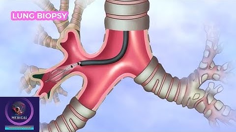 Lung Biopsy Procedure | Diagnose of Lung Disease |