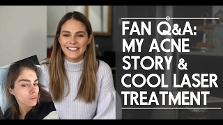 Fan Q&amp;A: My Acne Story &amp; My Cool Laser Treatment