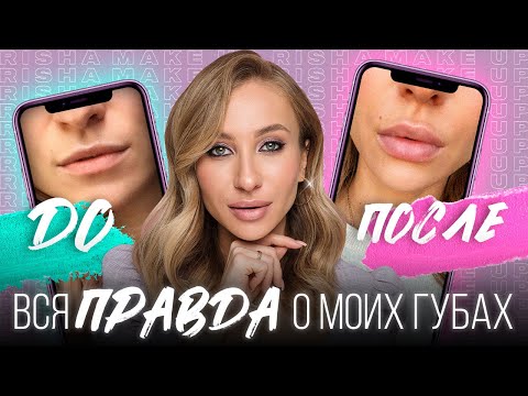 Инъекционное увеличение губ филлером: Мой опыт