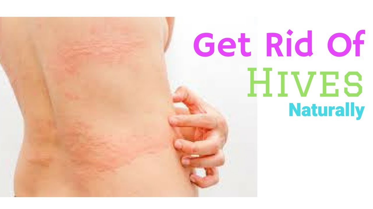 how to get rid of itchy hives fast