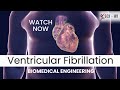 Ventricular fibrillation  sciwi  biomedical engineering