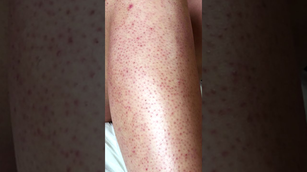 Красные точки на коже, фолликулярный кератоз, гусиная кожа - как избавиться