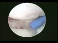 Arthroscopic view of distal radius articular fracture  dr alejandro badia