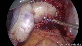 Laparoscopic management of Central Posterior Cervical Fibroid
