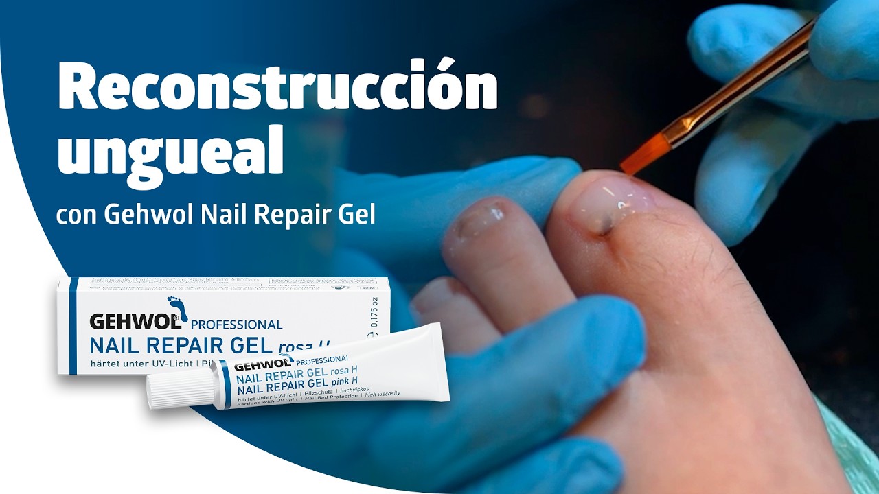 Reconstrucción de uña con Gehwol Nail Repair Gel - YouTube