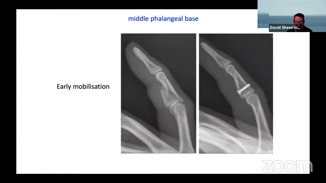 Injuries to the Proximal inter-Phalangeal Joint - Dr David Shewring