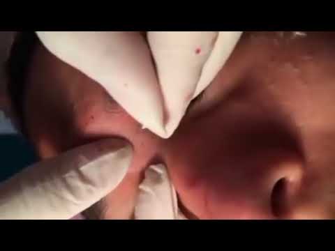 (AMAZING) !!! BEST BLACKHEAD REMOVE AND CYSTIC  REMOVE ON FACE (PART )