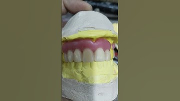 Removable Partial Denture Ready For Try In 😁😁😁#rpddentalprocedure #rpd#dentures #dentalartbyhaider