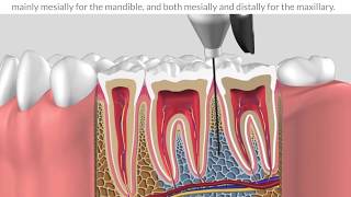 Protocole   intraosseous anesthesia