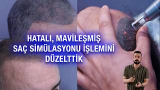 Saç simülasyonu silme ve düzeltme işlemi | Diyarbakır Saç Simülasyonu