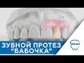 Зубной протез "Бабочка" - когда они показаны. Протезирование зубов