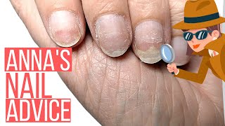 NAILS SEPARATING FROM NAIL BED!! ANNA HELP!!  [ANNA'S NAIL ADVICE]